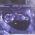 Mon avortement le 16/02/2010