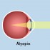 Myopie: correction par laser.