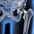 Arthroplastie de hanche.